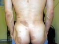 GENODERMATOSES - Neurofibromatosis (νon Recklinghausen