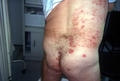SUPERFICIAL FUNGAL INFECTIONS - Tinea infection, multiple lesions
