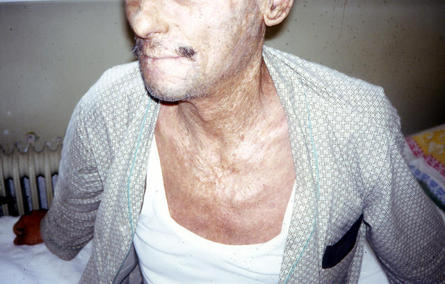 METABOLIC DISEASE, NUTRITION - Porphyria cutanea tarda METABOLIC DISEASE, NUTRITION - Porphyria cutanea tarda