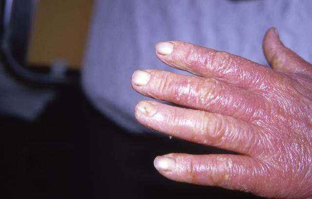 PSORIASIS - Pustular psoriasis