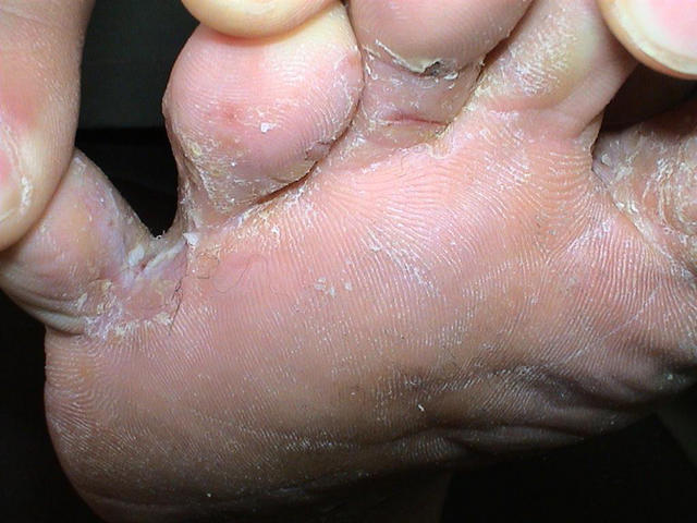 SUPERFICIAL FUNGAL INFECTIONS - Tinea
