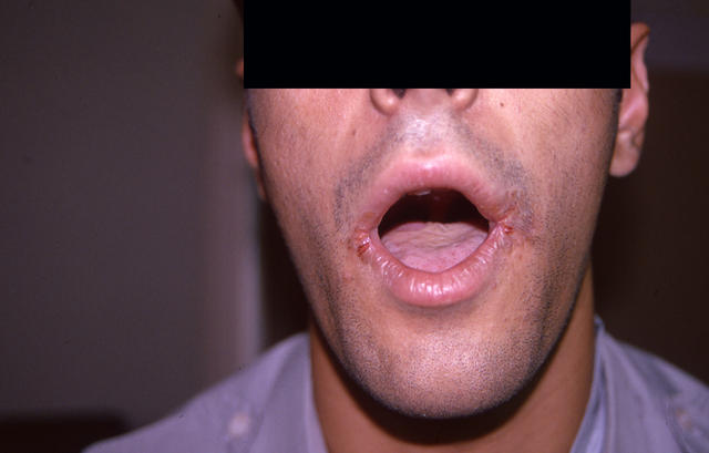 MUCOSAL LESIONS - Cheilitis, angular