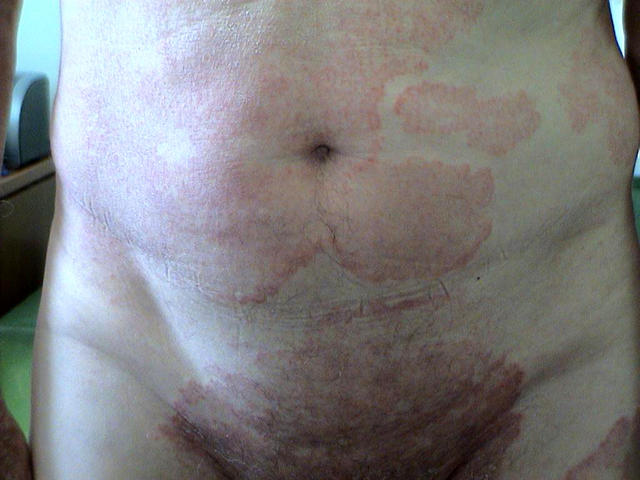 SUPERFICIAL FUNGAL INFECTIONS - Tinea infection SUPERFICIAL FUNGAL INFECTIONS - Tinea infection
