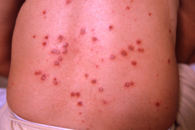 PSORIASIS - Psoriasis PSORIASIS - Psoriasis