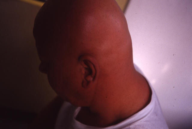 HAIR DISEASES - Alopecia Areata