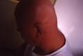 HAIR DISEASES - Alopecia Areata