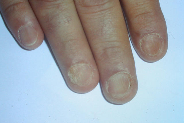 NAIL DISEASES - Lichen planus of the nails