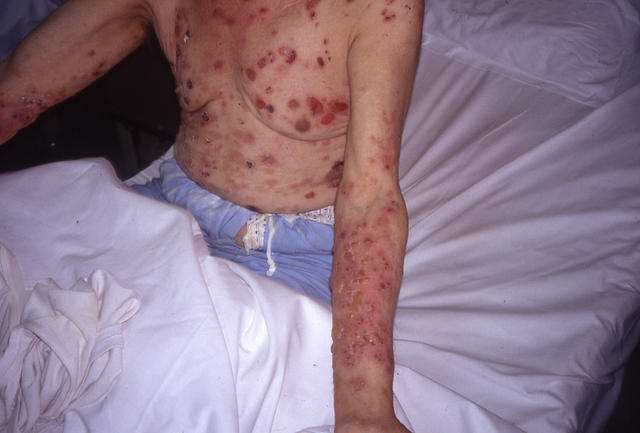 BULLOUS DISEASES - Bullous pemphigoid