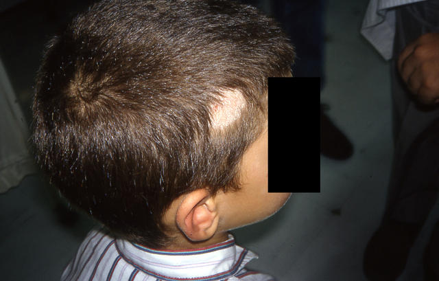 SUPERFICIAL FUNGAL INFECTIONS - Tinea capitis SUPERFICIAL FUNGAL INFECTIONS - Tinea capitis