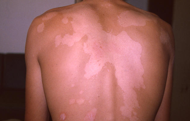SUPERFICIAL FUNGAL INFECTIONS - Pityriasis versicolor