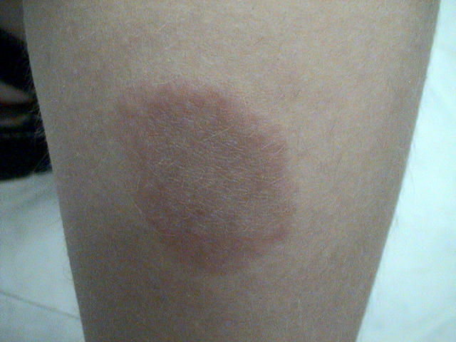 NECROBIOTIC DISORDERS - Granuloma Annulare NECROBIOTIC DISORDERS - Granuloma Annulare