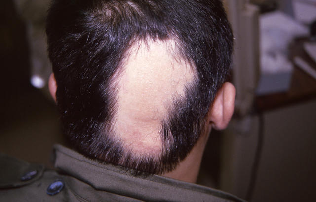 HAIR DISEASES - Alopecia Areata