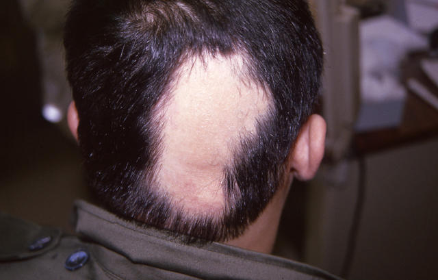 HAIR DISEASES - Alopecia Areata HAIR DISEASES - Alopecia Areata