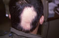 HAIR DISEASES - Alopecia Areata