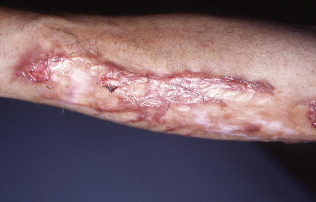 SOFT TISSUE TUMORS - Cheloids SOFT TISSUE TUMORS - Cheloids
