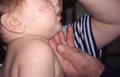 DISEASES OF THE SEBACEOUS GLANDS - Acne infantile