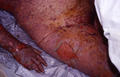 DRUG ERUPTIONS - Stevens - Johnson syndrome