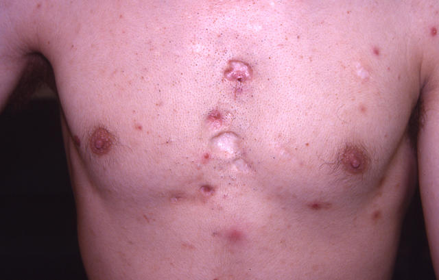 DISEASES OF THE SEBACEOUS GLANDS - Acne, Cystic