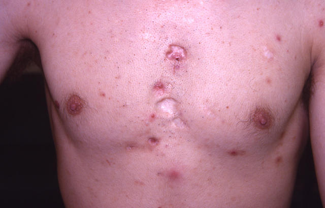 DISEASES OF THE SEBACEOUS GLANDS - Acne, Cystic DISEASES OF THE SEBACEOUS GLANDS - Acne, Cystic
