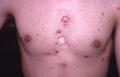 DISEASES OF THE SEBACEOUS GLANDS - Acne, Cystic