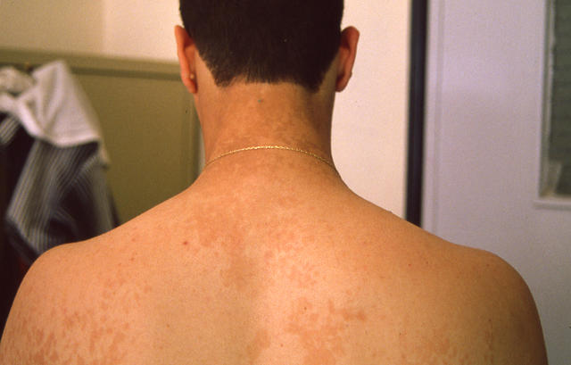 SUPERFICIAL FUNGAL INFECTIONS - Pityriasis versicolor