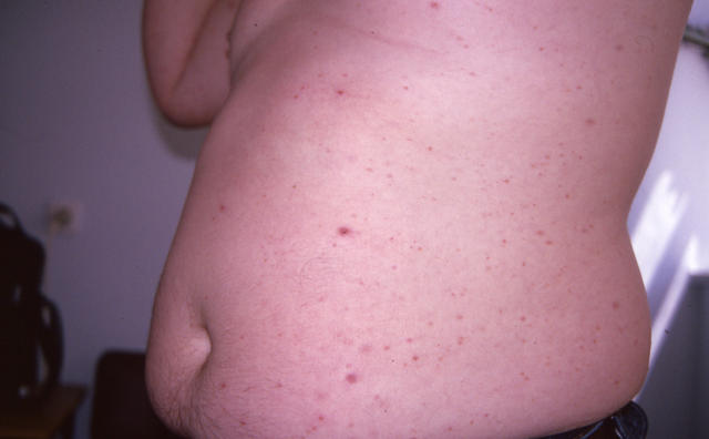 DISEASE OF THE BLOOD AND THE VESSELS – PURPURAS - Pityriasis lichenoides, acute