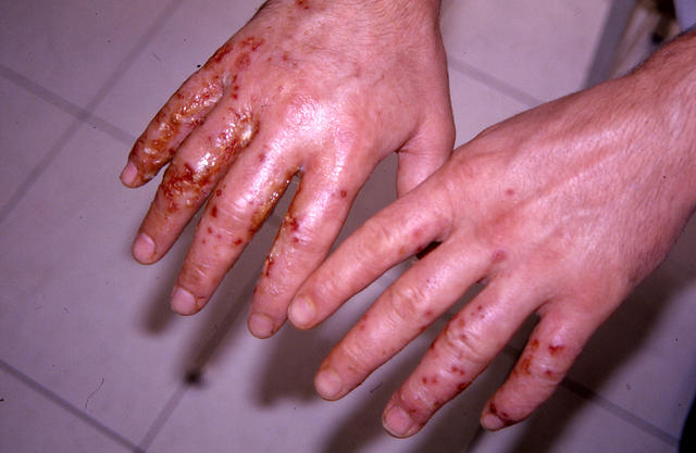 DERMATITIS - EKZEMA - Dyshidrotic eczema