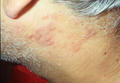 SUPERFICIAL FUNGAL INFECTIONS - Tinea infection