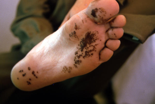 PIGMENTATION DISORDERS - Chromhidrosis PIGMENTATION DISORDERS - Chromhidrosis