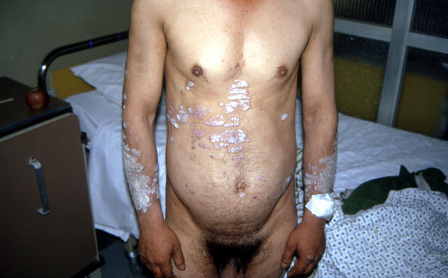 PSORIASIS - Plaque psoriasis