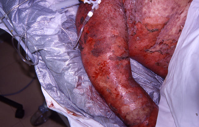 DRUG ERUPTIONS - Stevens - Johnson syndrome