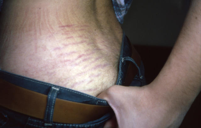 DRUG ERUPTIONS - Striae due to topical corticosteroids