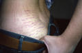 DRUG ERUPTIONS - Striae due to topical corticosteroids