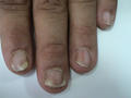 PSORIASIS - Psoriatic nails