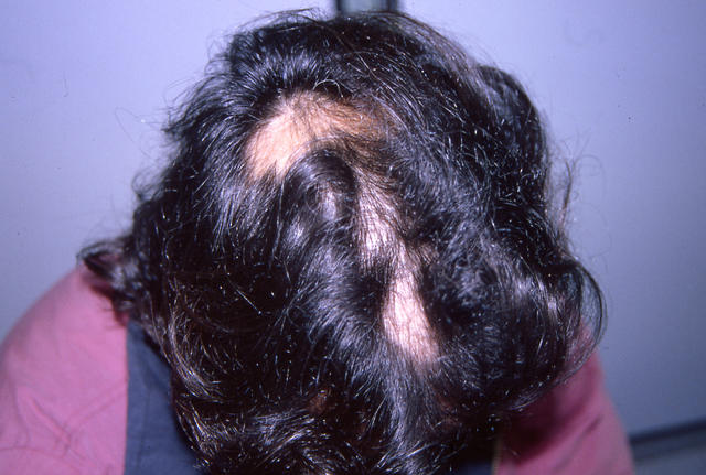 HAIR DISEASES - Alopecia Areata