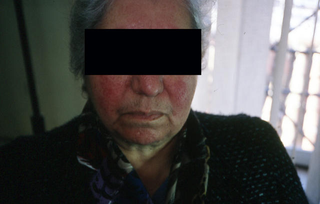DISEASES OF THE SEBACEOUS GLANDS - Rosacea DISEASES OF THE SEBACEOUS GLANDS - Rosacea