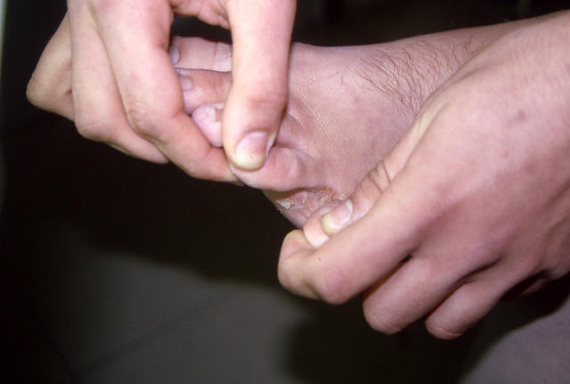 ΕΠΙΠΟΛΗΣ ΜΥΚΗΤΙΑΣΕΙΣ - Μυκητίαση Μεσοδακτυλίων πτυχών Ακρων ποδών (Athlet's foot)