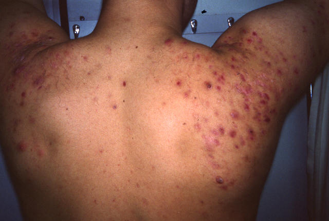 DISEASES OF THE SEBACEOUS GLANDS - Acne, Cystic DISEASES OF THE SEBACEOUS GLANDS - Acne, Cystic