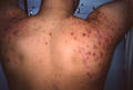 DISEASES OF THE SEBACEOUS GLANDS - Acne, Cystic