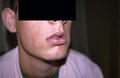 PIGMENTATION DISORDERS - Peutz - Jeghers syndrome