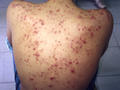 DISEASES OF THE SEBACEOUS GLANDS - Acne of the back