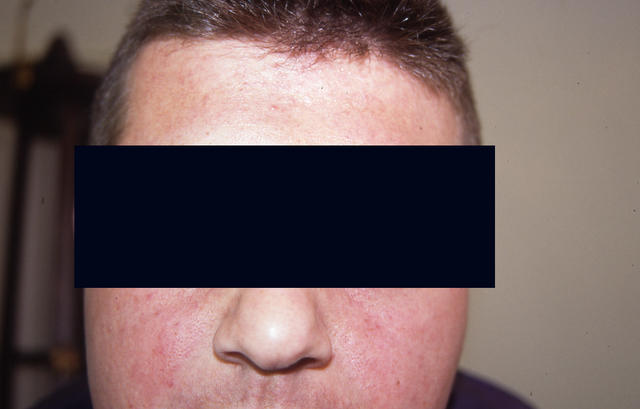 DISEASE OF THE BLOOD AND THE VESSELS – PURPURAS - Telangiectasias, face