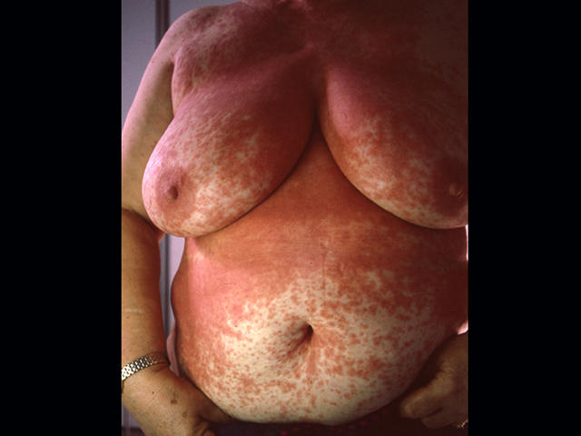 DRUG ERUPTIONS - Drug eruption DRUG ERUPTIONS - Drug eruption