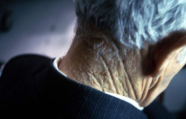 AGEING, PHOTOAGEING - Solar elastosis AGEING, PHOTOAGEING - Solar elastosis