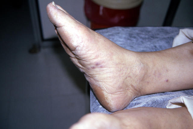 SOFT TISSUE TUMORS - Kaposi sarcoma SOFT TISSUE TUMORS - Kaposi sarcoma