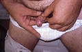 SYPHILIS AND OTHER SEXUAL TRANSMITTED DISEASES - Ulcer, primary syphilis