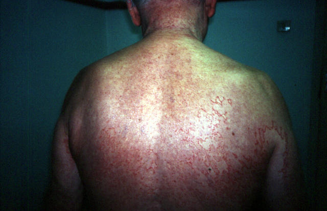 NECROBIOTIC DISORDERS - Granuloma Annulare, Generalised NECROBIOTIC DISORDERS - Granuloma Annulare, Generalised
