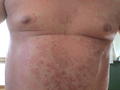 GENODERMATOSES - Netherton syndrome