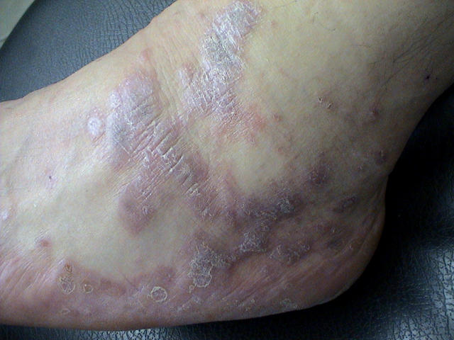 LICHEN - Hypertrophic lichen planus LICHEN - Hypertrophic lichen planus