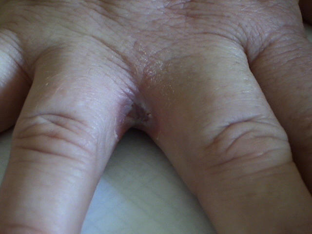 SUPERFICIAL FUNGAL INFECTIONS - Candidiasis